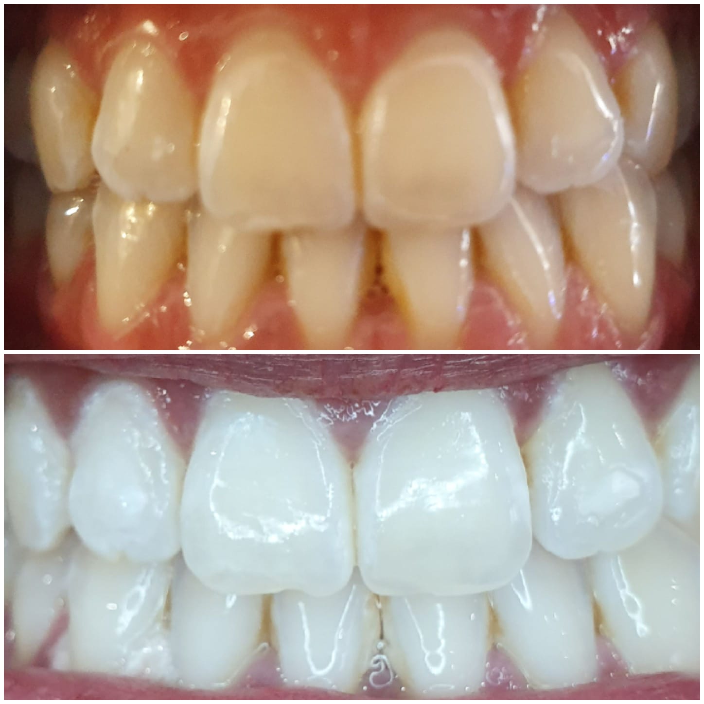 Teeth whitening clients results showcase