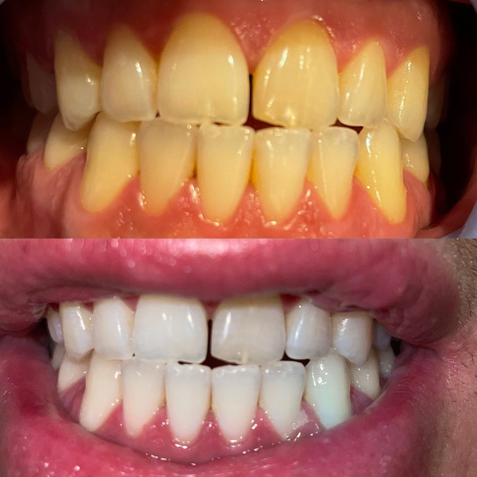 Teeth whitening clients results showcase