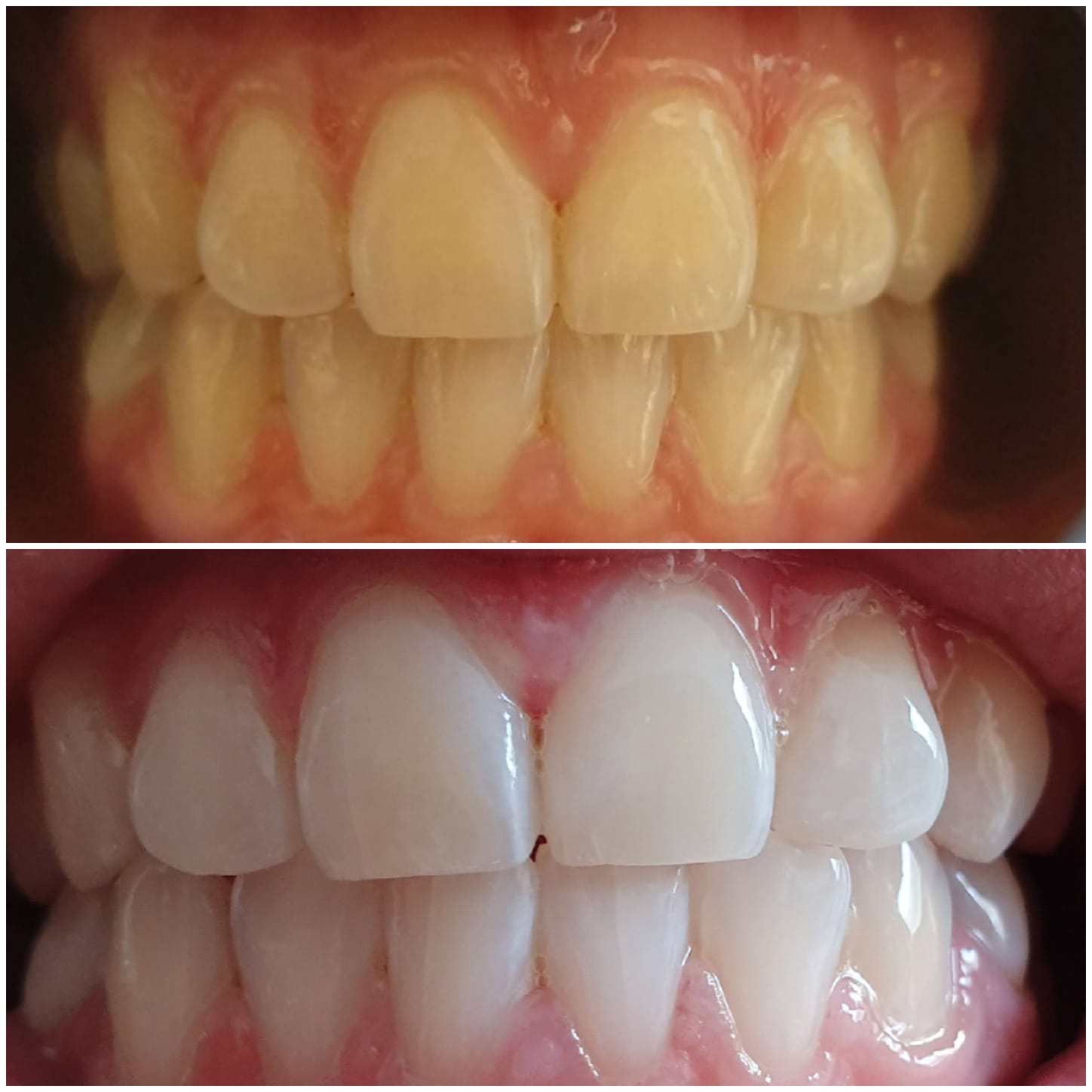 Teeth whitening clients results showcase