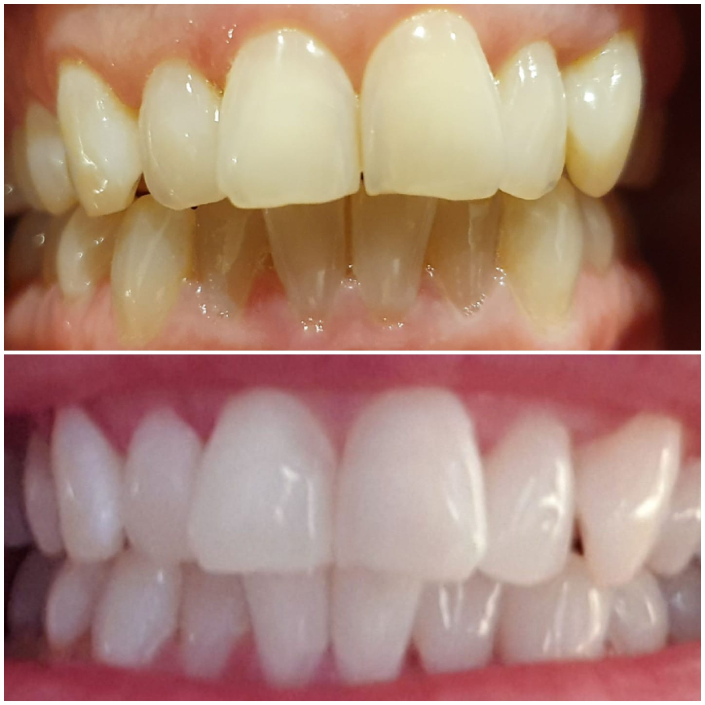 Teeth whitening clients results showcase