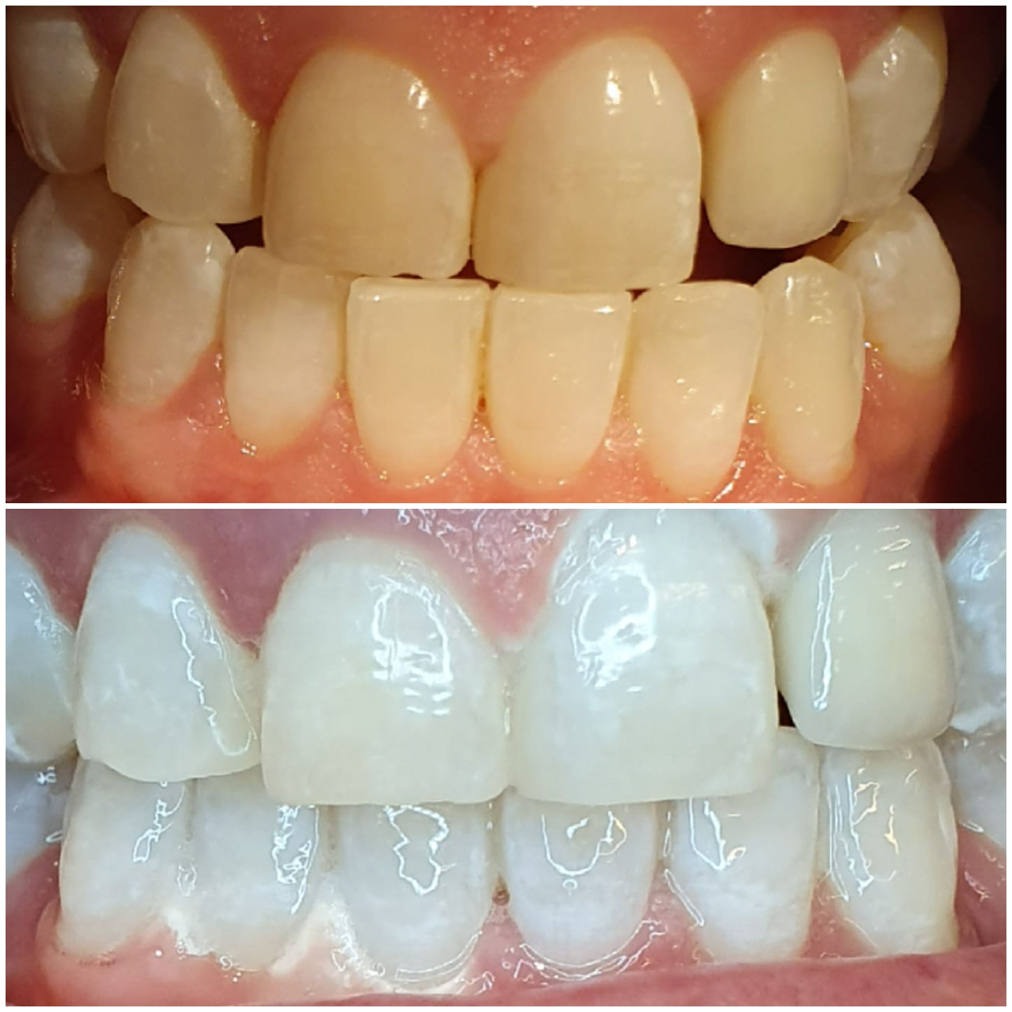 Teeth whitening clients results showcase