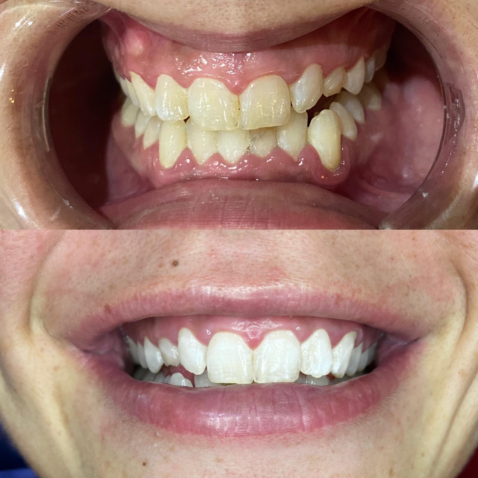 Teeth whitening clients results showcase